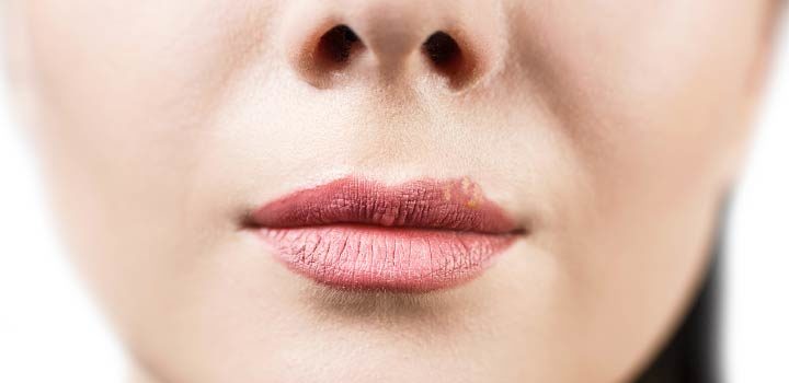 Rissige Lippen
