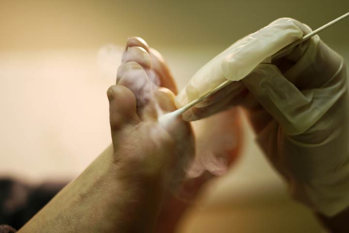 Kryotherapie Dornwarzen