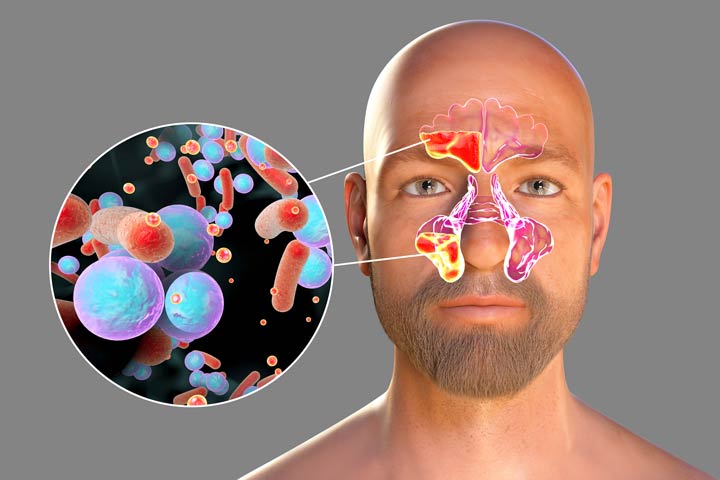 Chronische Sinusitis als Volkskrankheit