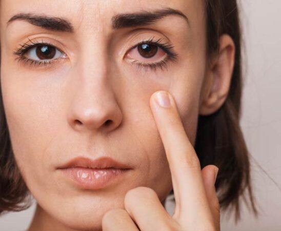 Gereizte Augen auf natürliche Weise beruhigen