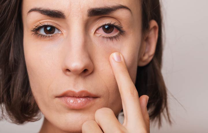 Gereizte Augen auf natürliche Weise beruhigen