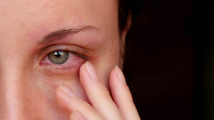 Merkmale und Ursachen von gereizten Augen